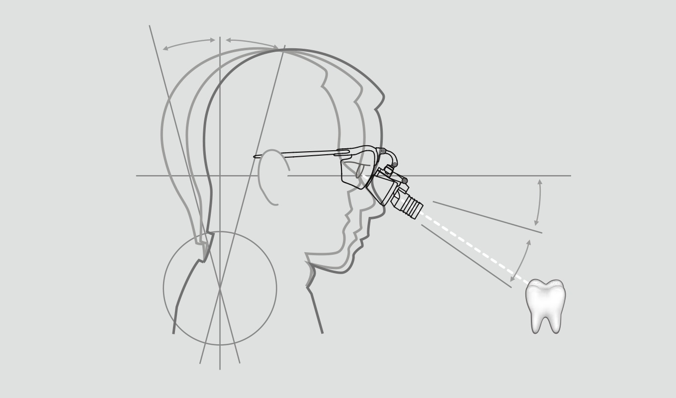 Comparaison entre une posture penchée sans loupes et une posture ergonomique